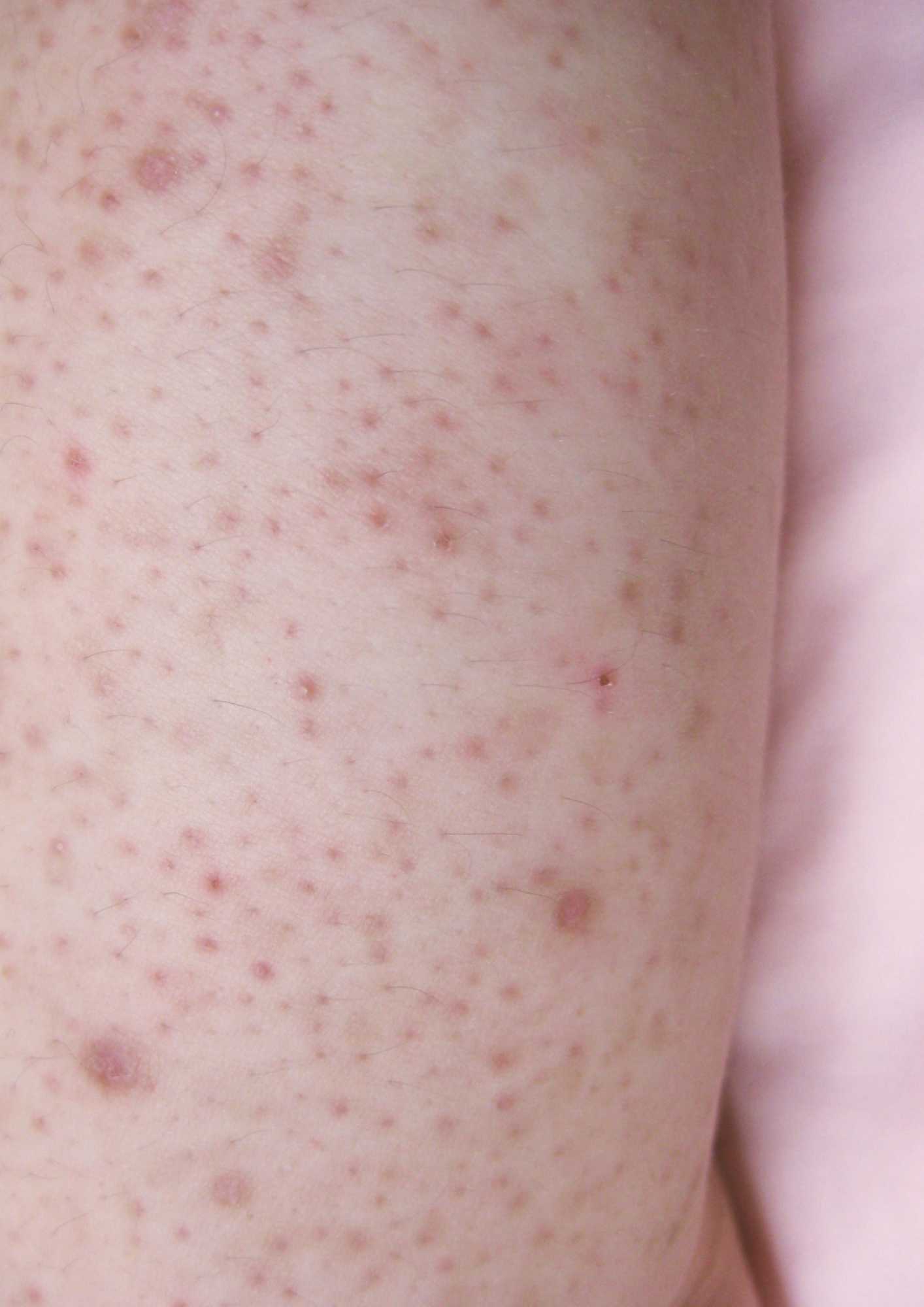 keratosis pilaris symtom